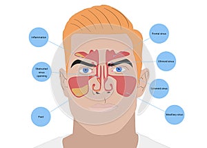 Illustration of man with healthy and inflammed paranasal sinuses on white background photo