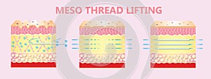 Illustration of meso threads lifting photo