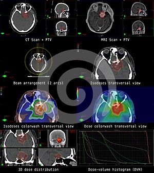 Illustration of a modern radiation plan for cancer therapy of a patient with a brain tumor meningioma.