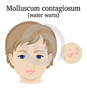 Illustration of Molluscum contagiosum photo