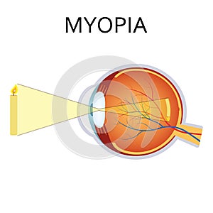 Illustration of myopia. photo