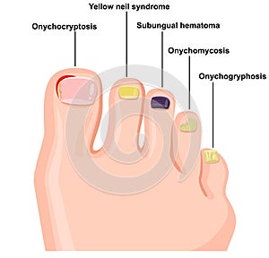 Illustration of nail diseases photo