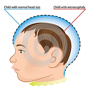 Illustration of a newborn baby with microcephaly disease