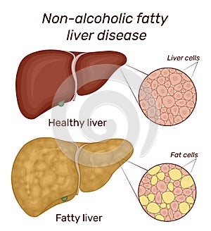 Illustration of non-alcoholic fatty liver disease