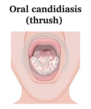 Illustration of Oral candidiasis