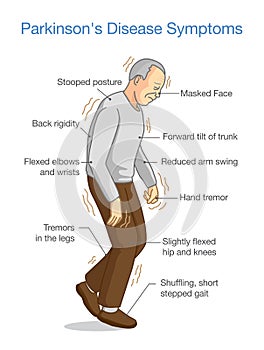 Illustration about Parkinson`s Disease Symptoms.