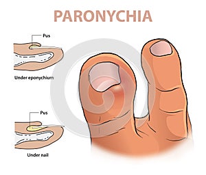 Illustration of paronychia on toe photo
