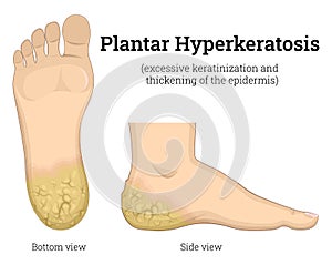 Illustration of Plantar Hyperkeratosis