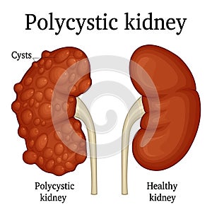 Illustration of polycystic kidney photo