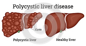 Illustration of polycystic liver disease