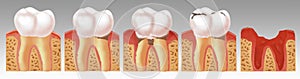 Illustration of the process of tooth decay