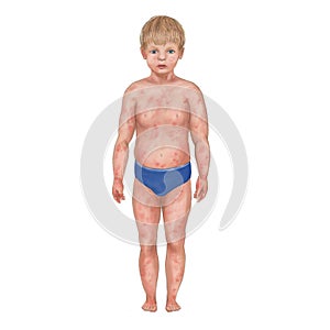 Illustration of the pruritus. Small boy with rashes isolated on white