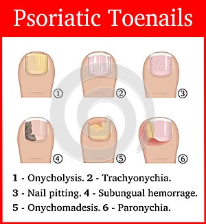 Illustration of Psoriatic toenails photo
