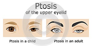 Illustration of Ptosis of the upper eyelid photo