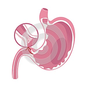 Illustration of Pyloric Stenosis disease