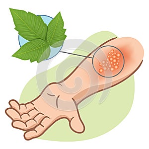 Illustration representing first aid arm with allergy and allergic rashes due to poison ivy poisoning