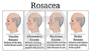 Illustration of Rosacea