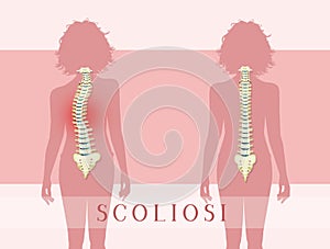 Illustration of scoliosis