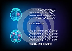 Illustration of seizure types demonstrating by onset and brain waves photo