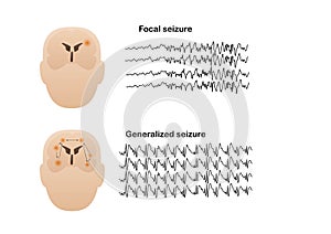 Illustration of seizure types demonstrating by onset and brain waves photo