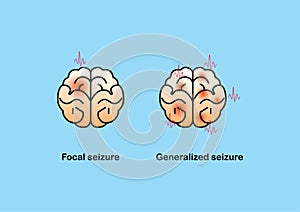 Illustration of seizure types demonstrating by onset and brain waves photo