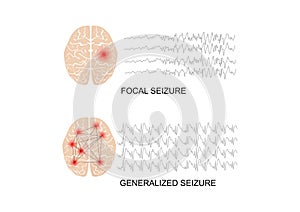 Illustration of seizure types demonstrating by onset and brain waves photo