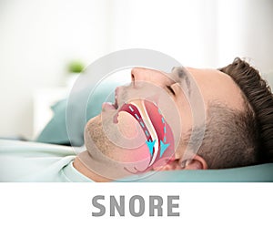 Illustration showing airway during snore