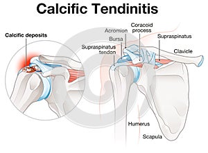 Calcific Tendinitis Shoulder Illustration. Labeled photo