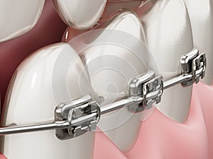 Illustration showing dental braces on straight teeth. 3D illustration