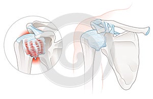 Frozen Shoulder Adhesive capsulitis Illustration. Labeled photo