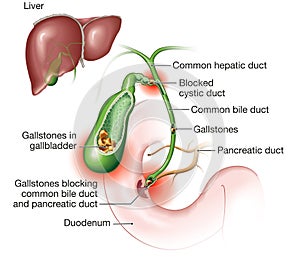 Gallstone disease. gallstones blocking bile duct and pancreatic duct. Labeled Illustration photo