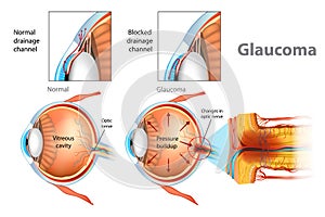 Illustration showing open-angle glaucoma.