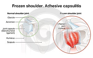 Frozen shoulder. Adhesive capsulitis surgery. Labeled Illustration photo
