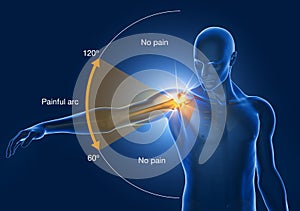 Shoulder Impingement, Painfull Arc, 3D Illustration photo