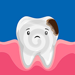 Illustration of sick tooth with caries.