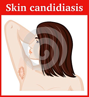 Illustration of skin candidiasis photo