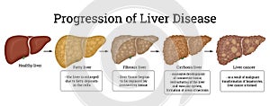 Illustration of the stages of liver damage