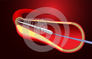 Illustration of stent implantation to support blood flow into the blood vessels