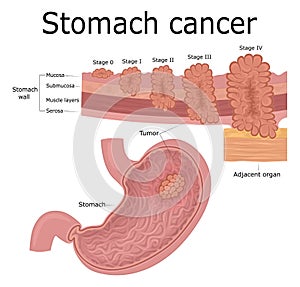 Illustration of stomach cancer photo