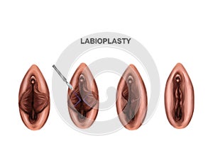 Illustration of the surgery to reduce the labia minora photo