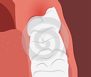 Illustration of teeth row with inflamed gum over the growing wisdom tooth.