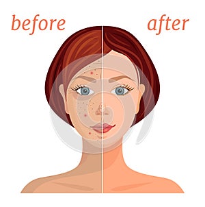 Illustration on the theme of skin care. Comparison of problem and healthy skin. Vector.