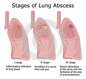 Stages of Lung Abscess photo