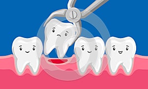 Illustration tooth is removed by forceps in oral cavity.