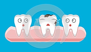 Illustration of tooth sectional view decay with caries dental health problem