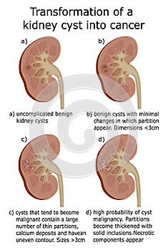 Illustration of transformation of a kidney cyst into cancer