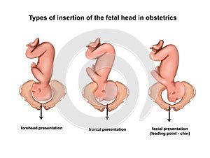 Types of insertion of the fetal head in obstetrics photo