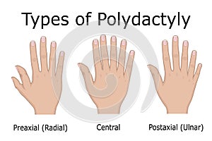 Illustration of Types of Polydactyly