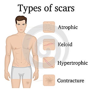 Illustration of the types of scars