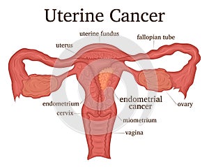 Illustration of uterine cancer